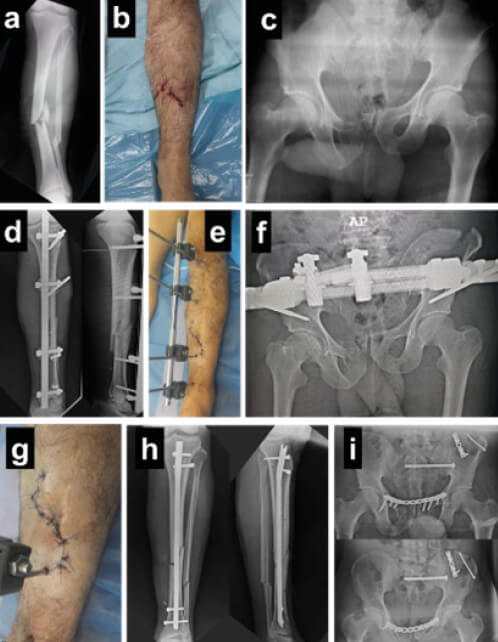 Figura 3. Paciente politraumatizado con fractura 42B2 (a), Gustilo y Anderson Grado II (b), y fractura de pelvis asociada (c), post-operatorio inmediato de fijación para CDO de la fractura de tibia (d y e) y de la pelvis (f). Una vez mejorada las condiciones del paciente y las de la herida (g), se realizó la conversión a osteosíntesis definitiva en la tibia (h) y RAFI de la pelvis (i).