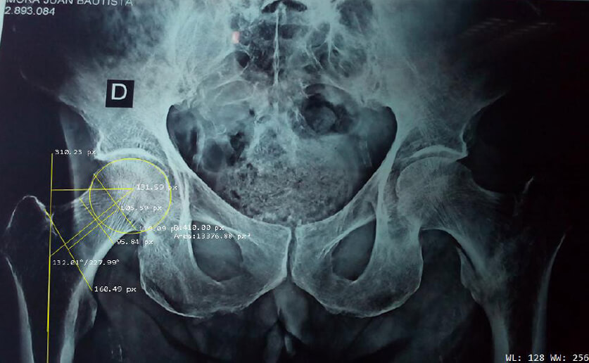 Figura 1. Imagen radiológica en proyección anteroposterior con todos los parámetros tomados en cuenta en nuestro estudio: ángulo cervicodiafisiario (ACD); lateralización femoral (OS); circunferencia cefálica (CC); longitud cervical (LC); ancho cervical (AF)