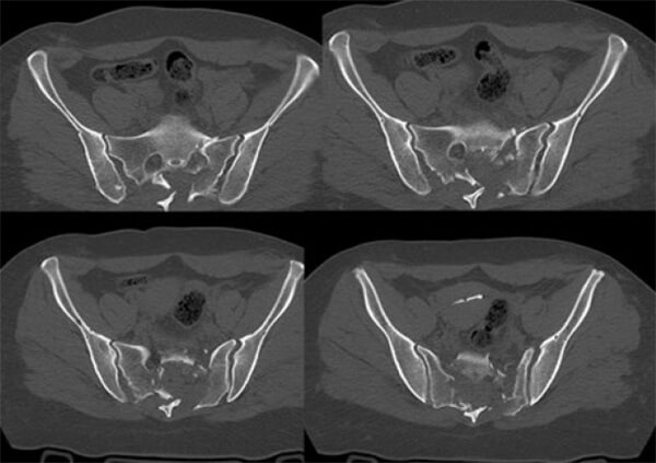 Figura 1. Tomografía Computarizada: cortes axiales. Se observa la inestabilidad vertical y rotacional, originada por la fractura de sacro bilateral, transforminal, con conminución que comprime los agujeros foraminales (S1-S2)