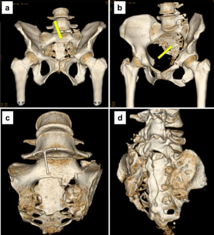 Figura 3. Tomografía Computarizada. Reconstrucción 3D. A: La porción craneal del sacro permanece unida a la columna lumbar. B: La porción caudal del sacro permanece en el Anillo Pélvico Posterior. C: Vista anterior del sacro. Patrón de fractura en H. D: Vista posterior. Compromiso de agujeros intraforaminales (S1-S2-S3)