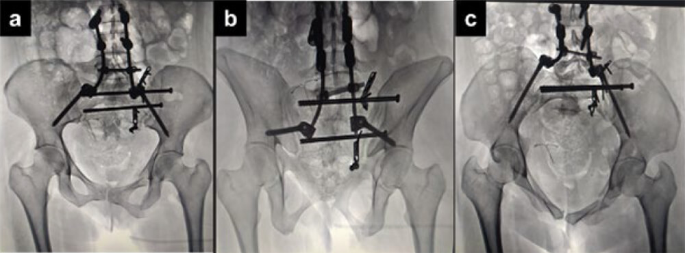 Figura 5. Proyecciones radiológicas anteroposterior (A), outlet (B) e inlet (C) post-operatorias.