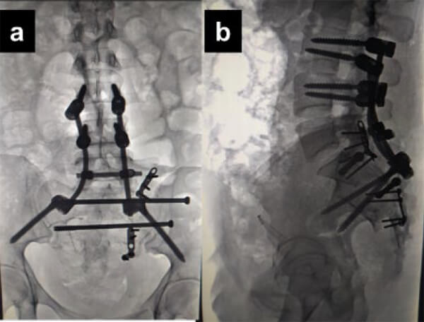 Figura 6. Proyecciones radiológicas anteroposterior (A) y lateral (B) post-operatorias de columna lumbo-sacra.