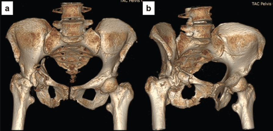 Figura 1. Tomografía Computarizada: 3D vista anterior donde se observa la conminución de la (CA) de acetábulo derecho (a). Patrón de fractura en T. Se observa el desplazamiento central de la cabeza femoral (b).