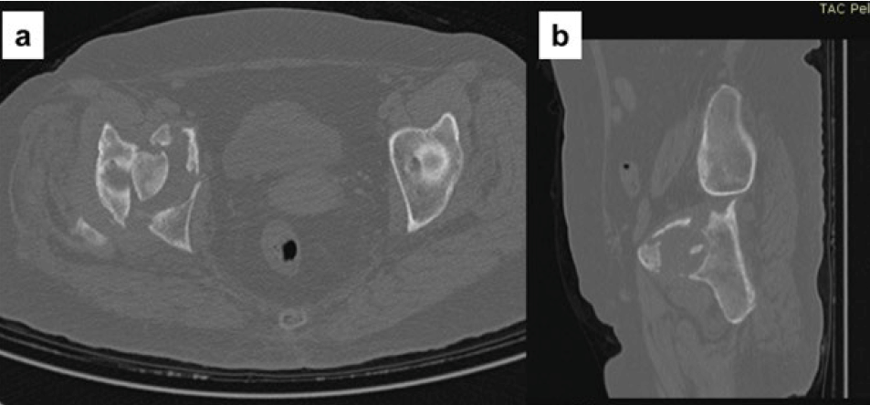 Figura 3. Tomografía computarizada: Cortes axial (a) y sagital (b). Se observa el compromiso de ambas columnas de acetábulo derecho.