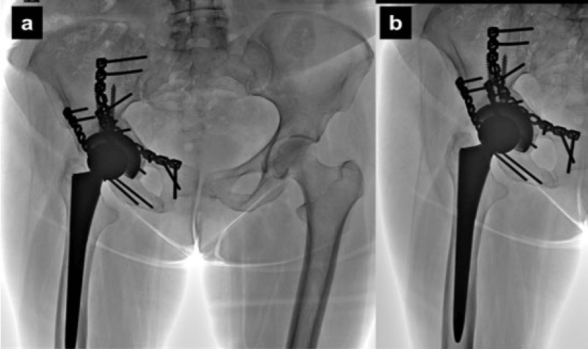 Figura 4. Resultados radiológicos post-operatorios. Radiografía anteroposterior de pelvis centrada en pubis (a). Radiografía de acetábulo proyección oblícua obturatriz (b)