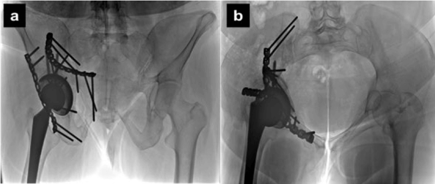 Figura 5. Resultados radiológicos post-operatorios. Radiografía Inlet (a) y Outlet (b) de Pelvis. Se observa reducción atómica, consolidación ósea, estabilidad de los componentes acetabular y femoral, no hay desplazamiento residual posterior a los 12 meses de la cirugía.
