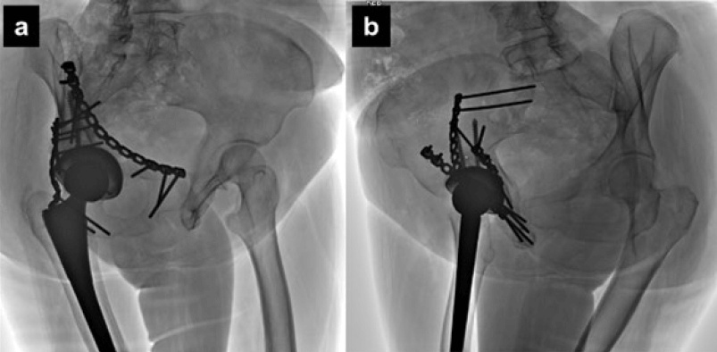 Figura 6. Resultados radiológicos post-operatorios. Radiografía oblícua Alar (a) y Obturatriz (b). A los 12 meses de la cirugía. Se observa restauración anatómica de las líneas pélvicas de Judet (Reducción anatómica de acuerdo a los criterios de Matta) adecuada orientación de los componentes acetabular y femoral.