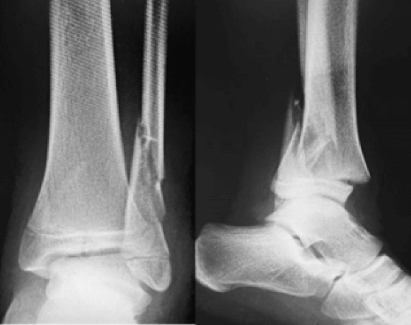Figura 1. Radiografía simple AP y lateral de tobillo izquierdo