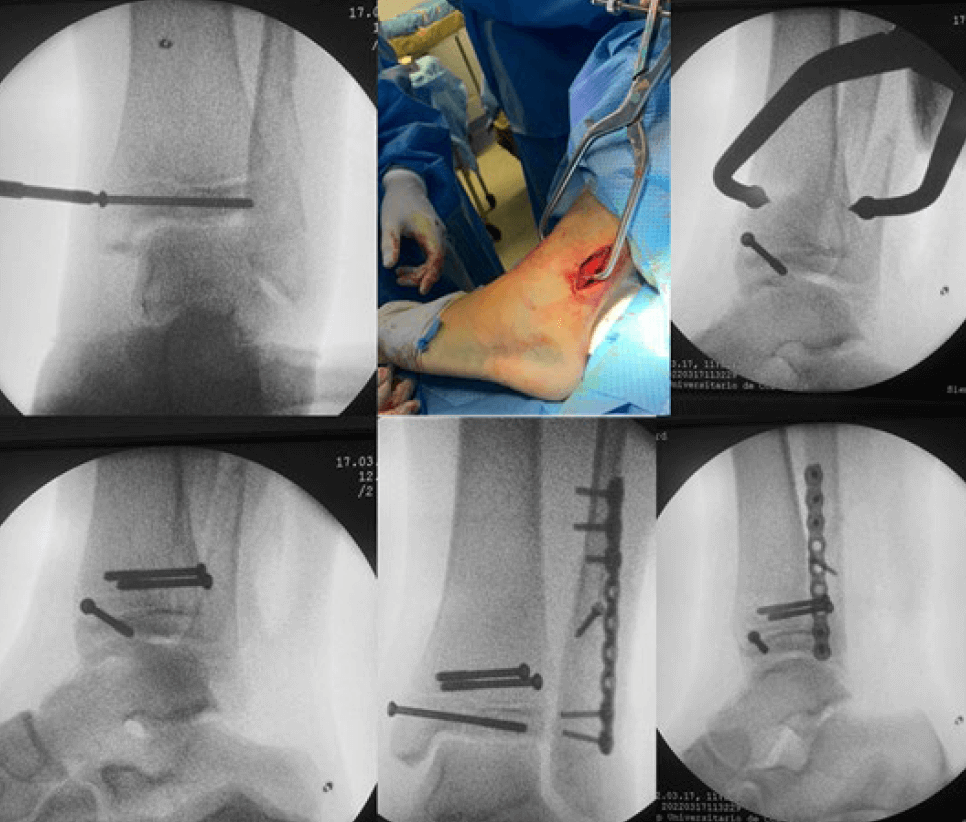 Figura 3. Imágenes del intraoperatorio.