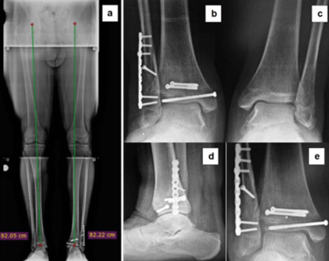 Figura 5. Postoperatorio tardío (6 meses de evolución). a: Panorámica de miembros inferiores. a y b: Radiografías simples en apoyo anteroposterior tobillo derecho e izquierdo. d y e: Radiografías simple de tobillo izquierdo lateral y mortaja