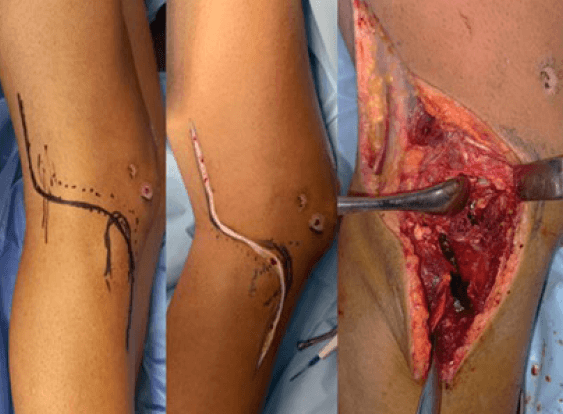 Figura 1. Abordaje en “S” itálica, el cual permite la visualización de la columna posterolateral de la meseta tibial y del segmento anterolateral simultáneamente.