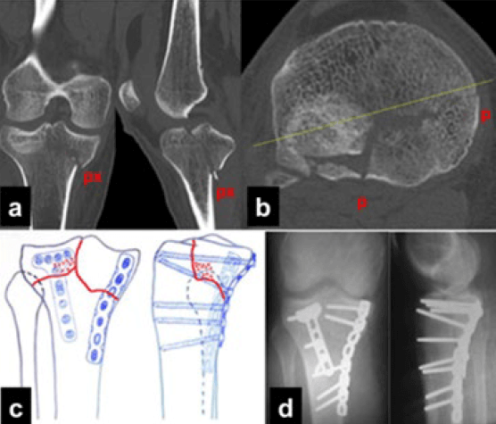 Figura 2. Paciente masculino de 33 años con diagnóstico de fractura tipo V PM + AL + PL según Schatzker-Kfuri. Imágenes a y b: Tomografía Computarizada Pre-Operatoria. c: Planificación Pre-Operatoria. d: Radiografías control Post-Operatorio.