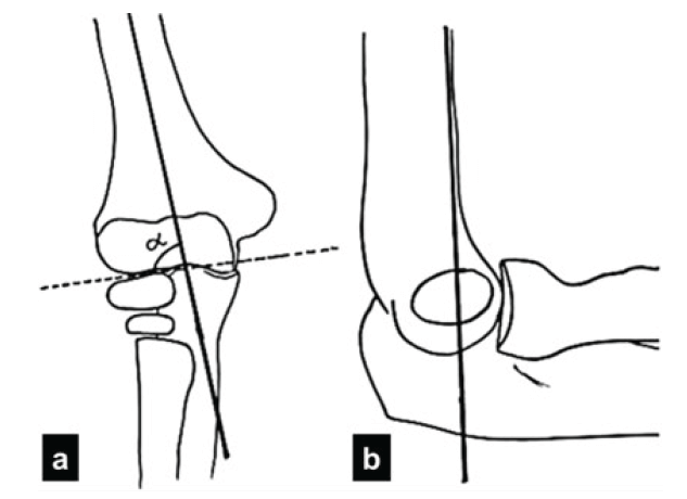 Figura 2. a: Ángulo de Baumann (α) y b: Línea humeral anterior.