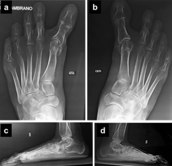 Figura 3. Radiografía anteroposterior (a y b) y lateral (c y d) bilaterales.