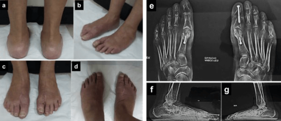 Figura 6. Resultados clínicos (a, b, c y d) y radiológicos (e, f, g) a las 12 semanas de post operatorio.