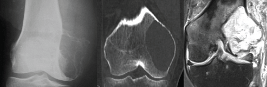 Figura 1. Estudios imagenológicos de rodilla (radiología, tomografía y resonancia magnética) donde se demuestran las características del tumor localizado en cóndilo medial, bien delimitado, adelgazando corticales y causando micro fracturas patológicas.