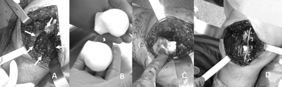 Figura 3. Imágenes del intra-operatorio de la cirugía realizada: A. Área de resección; B. Material de reconstrucción utilizada (cabezas femorales) C. Presentación en el defecto creado. D. Reconstrucción concluida (Fijación con placa de bloqueo).