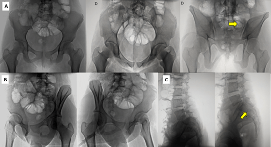 Figura 1. a- Rx. Preoperatoria. AP de pelvis centrada en pubis, Rx, Inlet y Outlet de pelvis, se observa el componente vertical de fractura en ala sacra izquierda (flecha amarilla). b-Rx. Preoperatorias oblicuo alar y Obturatriz. C- Rx. Preoperatoria lateral de región lumbosacra, se observa el trazo de fractura horizontal, desplazamiento posterior del fragmento proximal en el plano sagital.