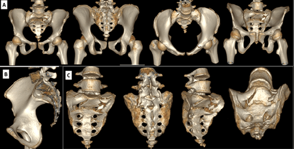 Figura 2. a- TAC 3D, se observa el trazo de fractura de sacro multiplanar, bilateral transforaminal, variante morfológica en U, desplazamiento craneal y posterior de hemipelvis izquierda, inestabilidad vertical y rotacional. Se observa fractura de rama iliopúbica izquierda. b- TAC 3D plano sagital, se evidencia trazo de fractura horizontal con desplazamiento posterior del fragmento proximal, que se correlaciona con la clasificación de Roy-Camille tipo II. c- TAC 3D, se observa visión 360º de sacro, evidenciándose la fractura con variante morfológica en U.