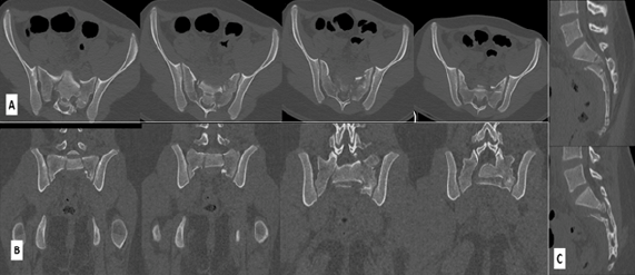 Figura 3. a- TAC axial se observa patron de fractura en U intraforaminal. b- TAC coronal, patron de fractura bilateral con cierto grado de conminuciòn en ala sacra izquierda. c- TAC sagital, se observa desplazamiento posterior del fragmento proximal.