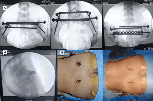 Figura 4. a- Control intraoperatorio bajo intensificador de imágenes de la reducciòn y fijaciòn con placa transiliaca posterior, bajo banda de tensiòn. b-Abordaje posterior del sacro minimamente invasivo.