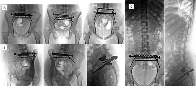 Figura 5. Rx. Control postoperatorio a los 6 meses observandose reducciòn y fijaciòn interna estable con proceso de consolidaciòn osea. A- Rx. AP de pelvis centrada en pubis, Rx. Outlet e inlet de pelvis. B-Radiografias Oblicuas de Judet. y Rx.lateral de region lumbo sacra, evidenciandose adecuado angulo de incidencia pelvica y correcta alineaciòn en el plano axial. C- Rx. AP y lateral de columna toraxica, lumbar y sacra.