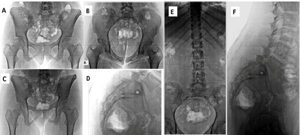 Figura 6. Rx. Control 7 meses del POT luego del retiro de material de sintesis, se evidencia consolidación osea de fractura sacra, no existe deformidad pelvica residual y correcta alineacion en el plano axial. A- Rx. AP de pelvis centrada en pubis. B- Rx. Inlet de pelvis. C- Rx. Outlet de pelvis. D-Rx. Lateral de región sacra. E- Rx. AP columna toraxica, lumbar y sacra. F- Rx. Lateral de columna toraxica, lumbar y sacra.