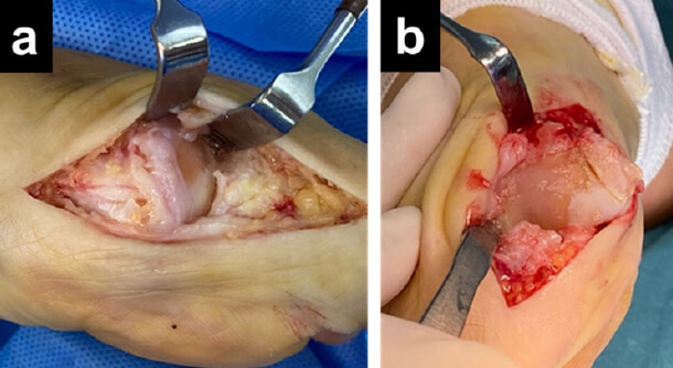 Figura 1. (a) Imagen de daño articular en paciente con HR estadio II de Coughlin. (b) Imagen de daño articular en paciente con HR estadio III de Coughlin.
