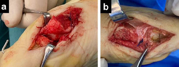 Figura 3. (a)Espacio articular luego de osteotomía de Watermann y previa artroplastia de interposición. (b) Artroplastia de interposición con capsula medial luego de osteotomía de Akin Moberg de 1era falange.