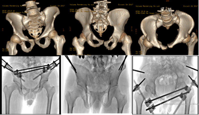 Figura 1. (A y B) Paciente masculino de 21 años de edad, quien posterior a accidente en moto presenta fractura pélvica inestable con desplazamiento traslacional vertical y rotacional por fractura sacra izquierda, es tratada al momento del accidente con fijación externa por otro equipo quirúrgico