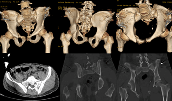 Figura 2. Imágenes de TC. Reconstrucción 3D y cortes axial y coronal de pelvis con fijador externo. Acude 3 meses después de la lesión con dolor y deformidad traslacional vertical de 3 cm, deformidad rotacional de 15º, desplazamiento posterior de 2 cm, se observa la falta de reducción del arco posterior con trazo vertical de fractura transforaminal sacra a través de S1, S2
y S3. Se ingresa con diagnóstico de: Fractura de pelvis inveterada Tile C AO 61C1.3c. Fractura de Sacro Denis II derecho.