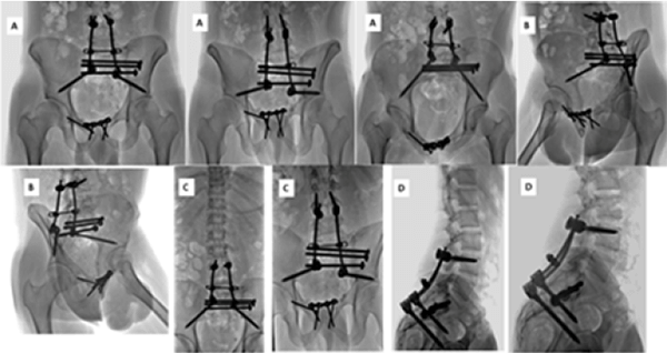 Figura 3. Imágenes de TC. Reconstrucción 3D y cortes axial y coronal de pelvis con fijador externo. Acude 3 meses después de la lesión con dolor y deformidad traslacional vertical de 3 cm, deformidad rotacional de 15º, desplazamiento posterior de 2 cm, se observa la falta de reducción del arco posterior con trazo vertical de fractura transforaminal sacra a través de S1, S2 y S3. Se ingresa con diagnóstico de: Fractura de pelvis inveterada Tile C AO 61C1.3c. Fractura de Sacro Denis II derecho