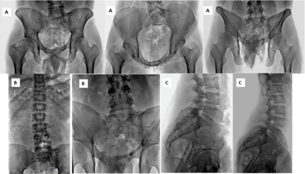 Figura 4. Rx. Control POT con el retiro de material de síntesis programado, cumpliendo 5 años de seguimiento de la cirugía de reconstrucción.