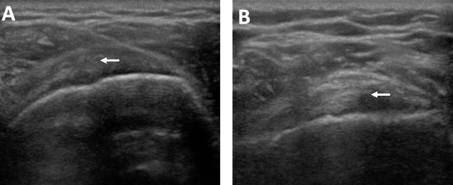 Figura 1. Colocación de plasma en la lesión, se puede apreciar con la letra A marcado con una flecha la lesión bursal en el supraespinoso. B. Evidencia la lesión con el plasma colocado, marcado con una flecha, donde se ven los cambios hiperecoicos correspondientes al plasma dentro de la lesión.
