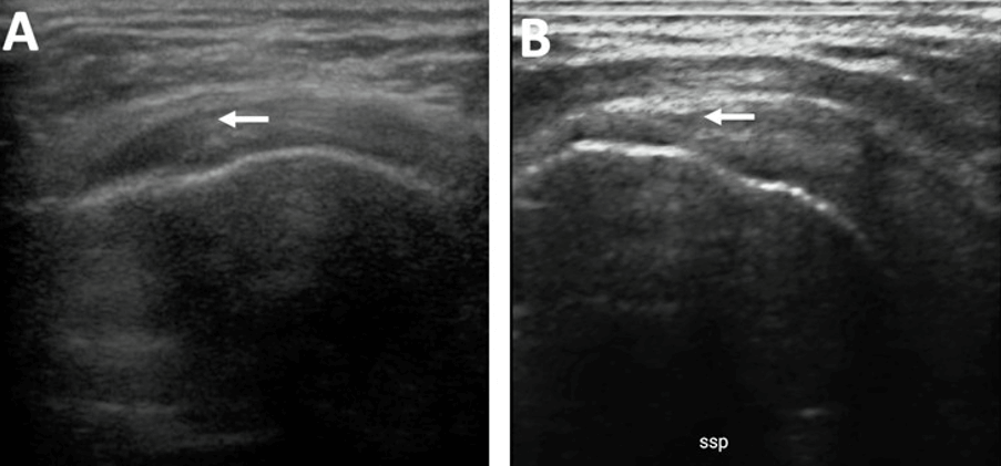 Figura 2. Comparativa primer y último eco. A: marcado con una flecha se evidencia la lesión bursal del primer eco. B: marcado con una flecha donde estaba la lesión y no se evidencia en el eco control del 3er mes