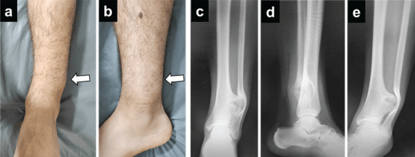 Figura 1. a y b: Fotos clínicas que muestran la masa redondeada en el tobillo (flechas). c, d y e: Radiografías del tobillo en proyecciones triplanares dónde igualmente se evidencia la lesión ósea de la tibia distal y la erosión y deformidad el peroné.