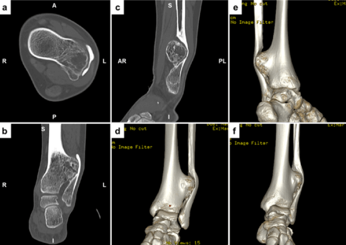 Figura 2. Imágenes de Tomografía Computarizada en sus cortes axial (a), coronal (b) y sagital (c), así como de reconstrucción 3D (d, e y f).