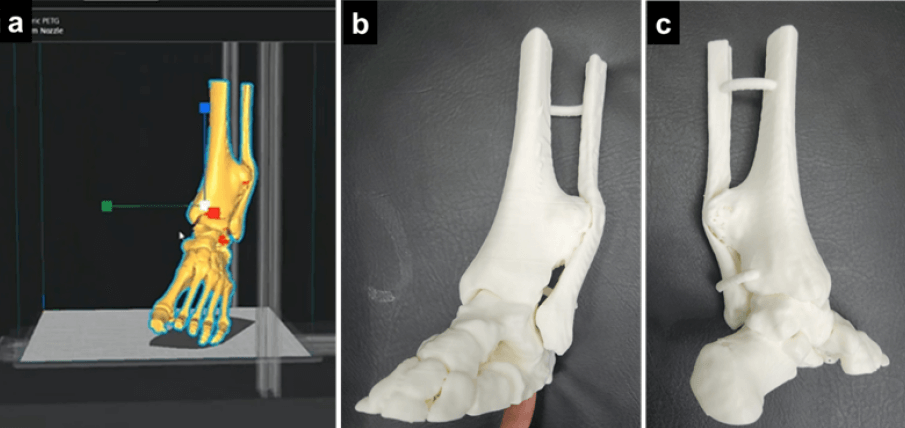 Figura 3. (a) Procesamiento de imagen a STL para la impresión 3D del modelo a partir de las imágenes obtenidas en la TC. (b y c) Modelo en 3D impreso para planificación.