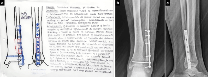 Figura 5. a: Planificación Pre-Operatoria de la reconstrucción. b y c: Resultados radiológicos post- operatorios en radiografías simples del tobillo en sus proyecciones anteroposterior y lateral.