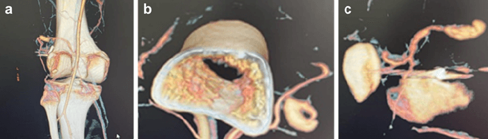 Figura 2. Imágenes de Angiotac que muestra pseudoaneurisma en arteria geniculada superoexterna corte coronal (a) axial (b) y sagital (c)
