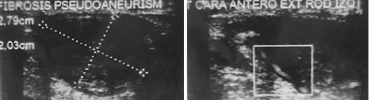 Figura 3. Imágenes del ECO Doppler que muestra la trombofibrosis del aneurisma, y el flujo arterial conservado