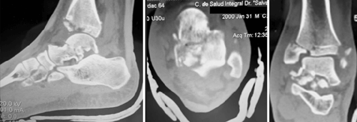 Figura 1. Tomografía Computarizada preoperatoria. Se aprecia la conminución de cuerpo y cuello astragalino.