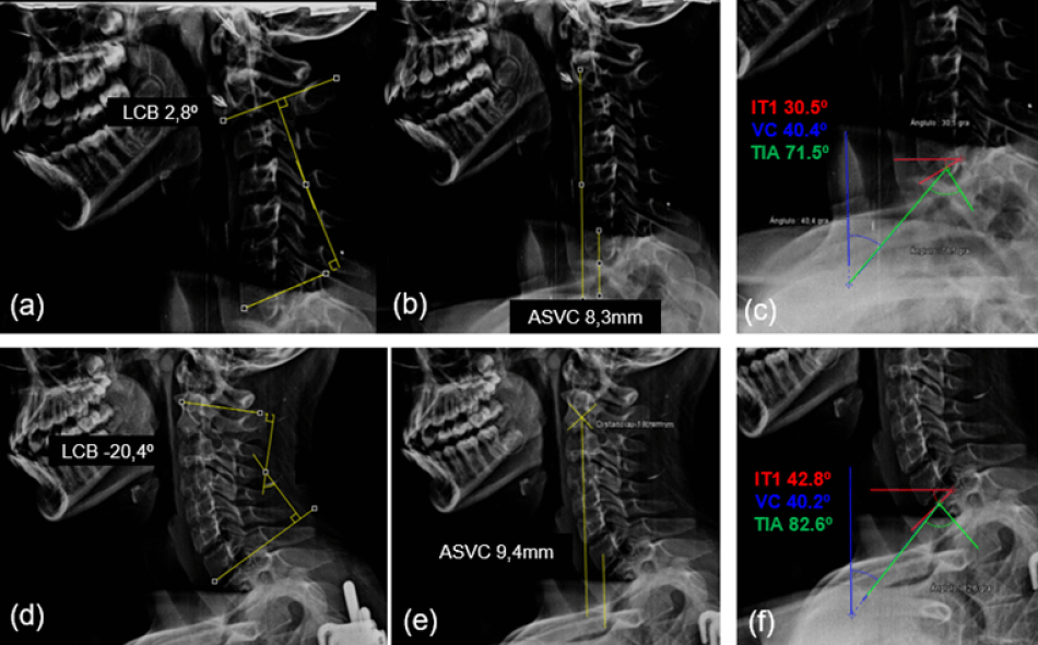 Figura 1. Parámetros radiológicos utilizados para el análisis del balance sagital cervical en uno de los pacientes del estudio. Parámetros cervicales radiológicos preoperatorios observados en las figuras (a,b,c) y sus respectivos cambios radiológicos postoperatorios representados en las imágenes (d,e,f)