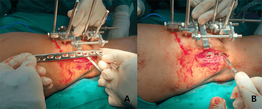 Foto 2. A) Presentación de placa recta 4.5mm bloqueada sobre la extremidad para constatar suficiencia de longitud. B) Se coloca placa recta 4.5mm bloqueada por técnica deslizamiento submuscular.