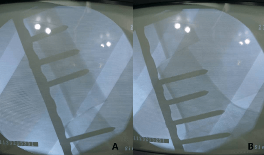 Foto 3. Visualización a través de monitor del intensificador de imágenes de osteosíntesis con placa recta bloqueada 4.5mm con colocación de 4 tornillos proximales (A) y 4 tornillos distales (B). Importante que en ambas se visualiza efecto de traslación a nivel femoral como regla #2 de las osteotomías.