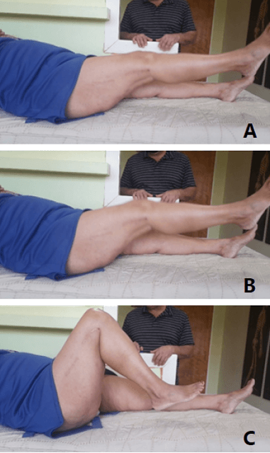 Foto 5. (A-B-C) Se visualiza paciente femenino con 7 años de evolución operada con la técnica descrita quien moviliza rodilla de manera activa alcanzando diferentes grados de flexión sin dolor.