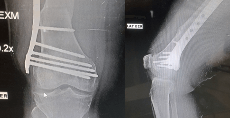 Foto 6. Se visualiza radiografía anteroposterior (A) y lateral (B) de rodilla derecha de paciente femenino con 7 años de evolución operada con la técnica descrita, evidenciándose en fémur distal consolidación y remodelación en el sitio de la osteotomía, además de la apertura de los espacios articulares femorotibiales (A).