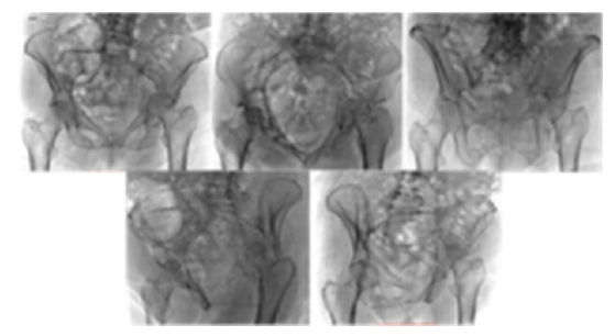 Figura 1. Se observa las 5 proyecciones radiológicas estándar de una paciente femenina de 93 años, quien posterior a caída de su propia altura, presenta fractura de (AC) de acetábulo izquierdo.