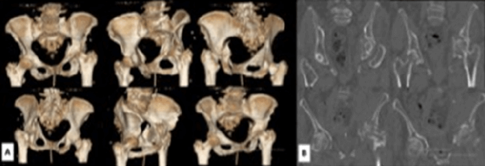 Figura 2. TAC 3D se observa la afectación de AC de acetábulo izquierdo, compromiso de la CA y lámina cuadrilátera, conminución e impactación del techo supero medial. B- TAC Coronal, desplazamiento medial de la cabeza femoral.
