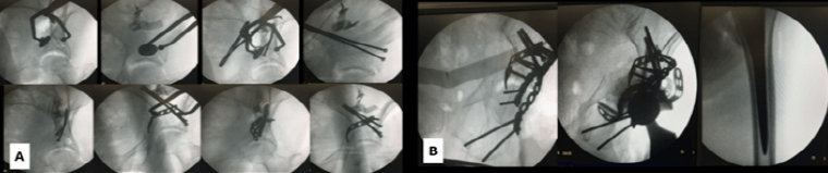 Figura 3. A- Control intraoperatorio con intensificador de imágenes. Reducción y fijación de la CA y lámina cuadrilátera, a través de abordaje ventana lateral (II) + SM. B- Reducción y fijación de la Col. Post. en un segundo tiempo quirúrgico a través de abordaje de KL. En vista al grado de conminución, stock óseo disminuido y a la impactación articular se decide realizar tratamiento con ORIF+ATC aguda, utilizando un anillo de reconstrucción acetabular con anclaje al ilion e isquion.